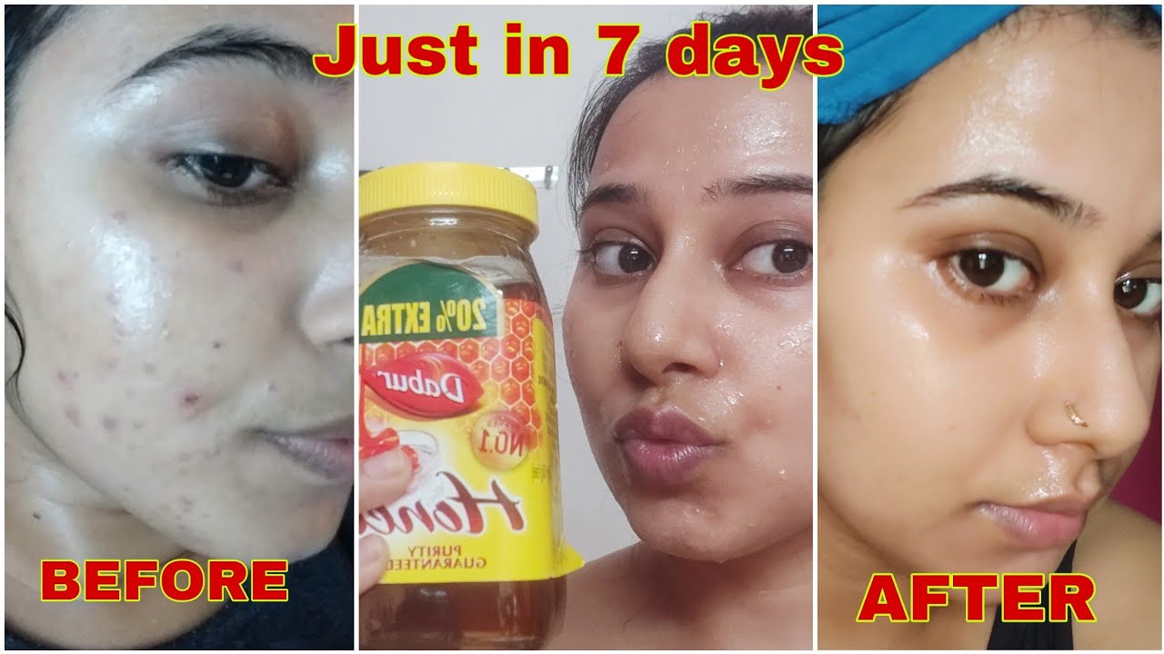 7 days Challenge- Remove Pimple Marks & Acne Scars Naturally at Home | पिंपल्स के दाग हटाने के उपाय