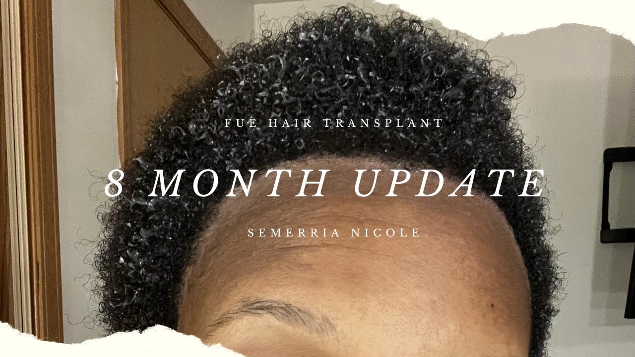8 MONTH FUE HAIR TRANSPLANT UPDATE| TURKEY LONGEVITA