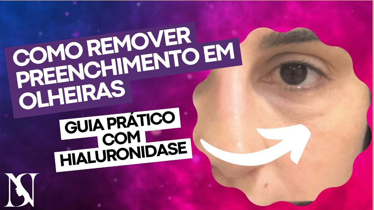 COMO REMOVER PREENCHIMENTO EM OLHEIRAS: Guia Prático com Hialuronidase