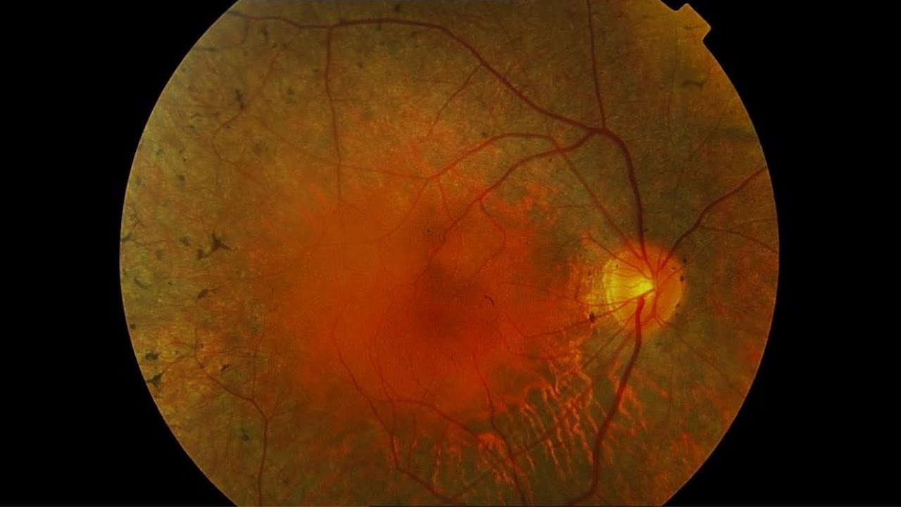 Nuevos tratamientos en la retinosis pigmentaria (Ceguera nocturna)