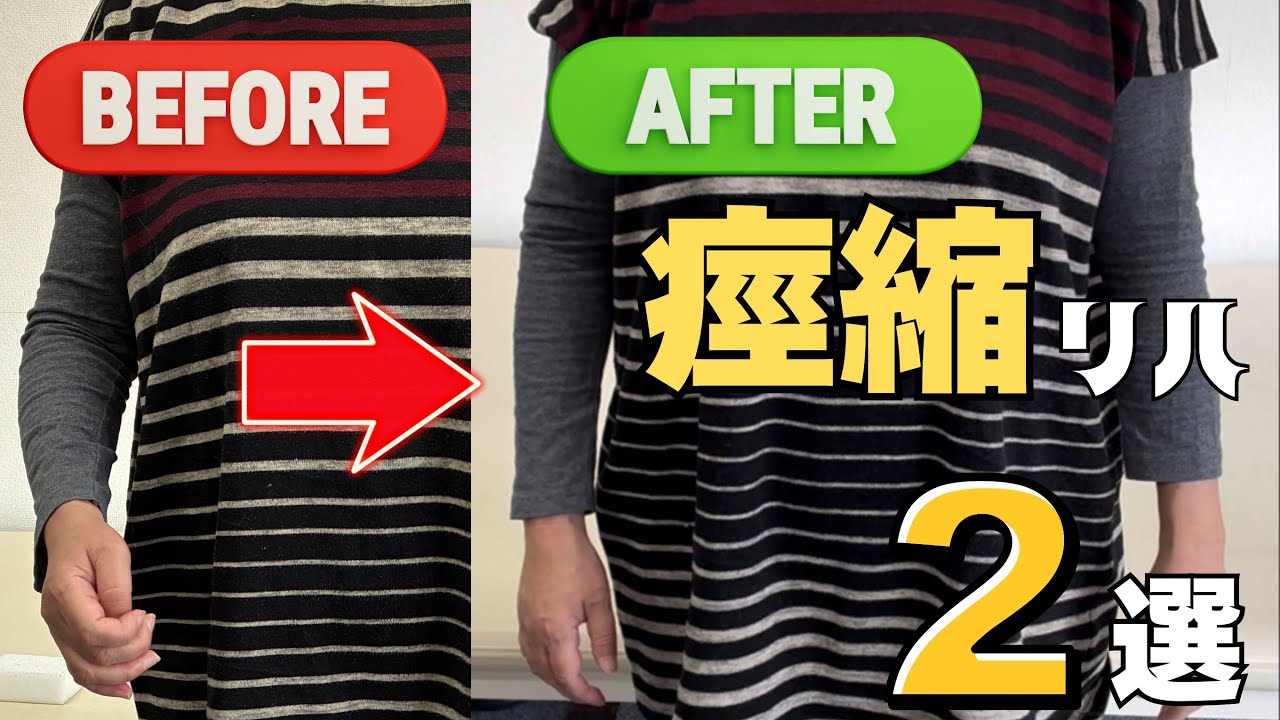 【テーマは非麻痺側と脱力】肘と指の痙縮を緩める2つの自主トレ