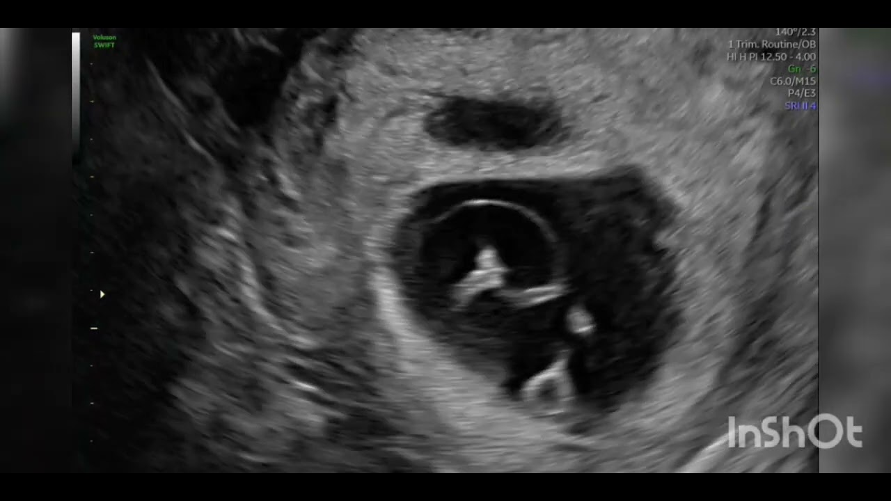 Twin reversed arterial perfusion (TRAP) sequence ( acardia) fetal ultrasound.
