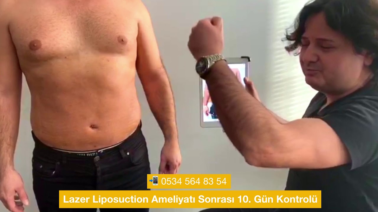 Lazer liposuction ameliyatı sonrası 10  gün kontrolü - Op. Dr. Onurkan İdacı