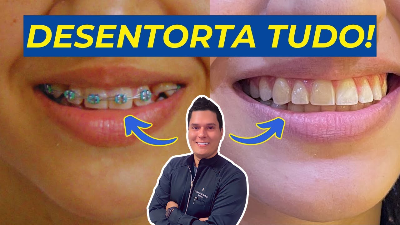 DENTES TORTOS CORRIGIDOS EM FORTALEZA-CE (ANTES X DEPOIS)
