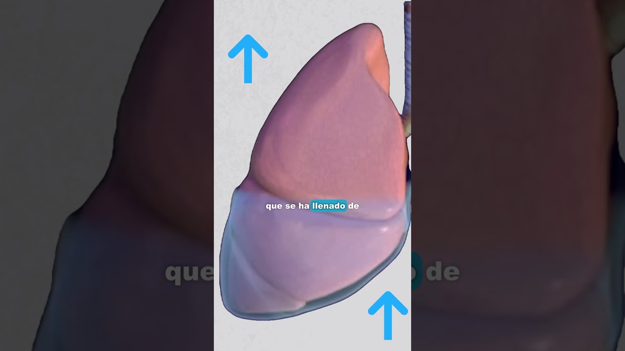 &iquest;Qu&eacute; es el derrame pleural?