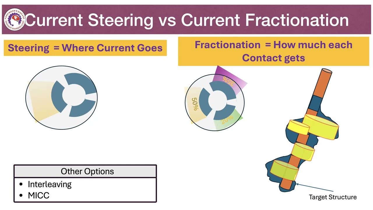 Directional Deep Brain Stimulation Explained | Steering & the Future of DBS