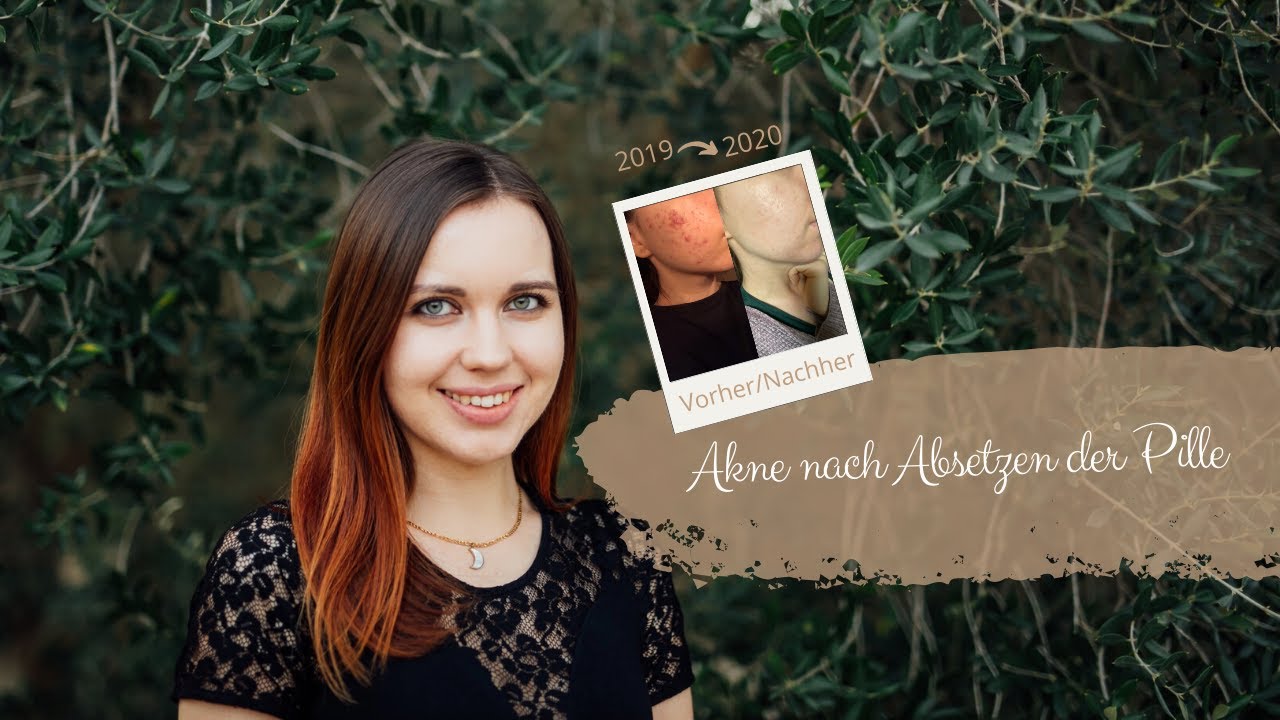 Akne nach Absetzen der Pille? Meine Tipps!