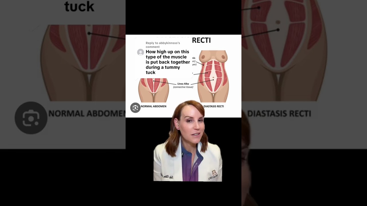 How do you put the muscles back together during a Tummy Tuck?