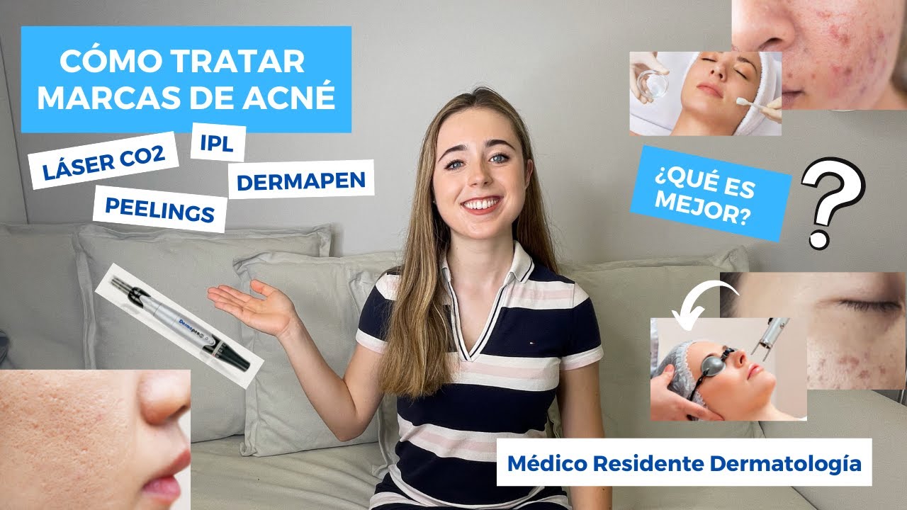 CÓMO TRATAR MARCAS DE ACNÉ EN LA CARA SEPTIEMBRE 2021 | LÁSER CO2, PEELINGS, DERMAPEN... ¿EL MEJOR?