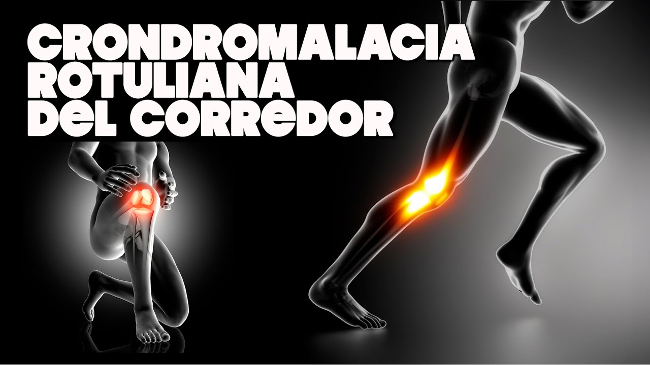 🏃 CONDROMALACIA ROTULIANA ➡ Motivos y Soluciones🦵. #682