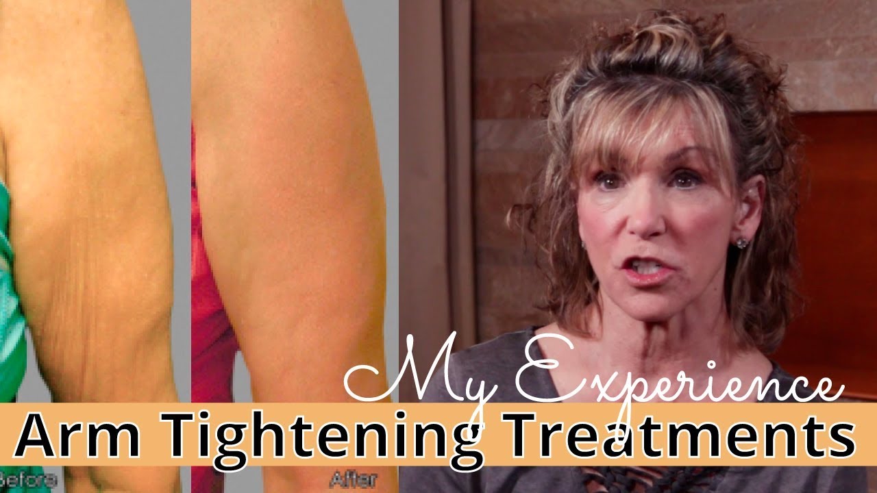 My Experience with USRF [Exilis Ultra] Non-Surgical Skin Tightening for Arms & Neck
