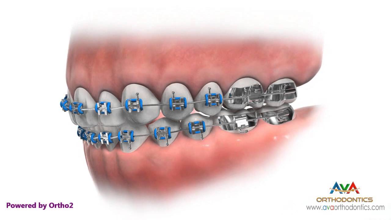 Жизнь с брекетами: чистка зубов, использование зубной нити и использование каппы