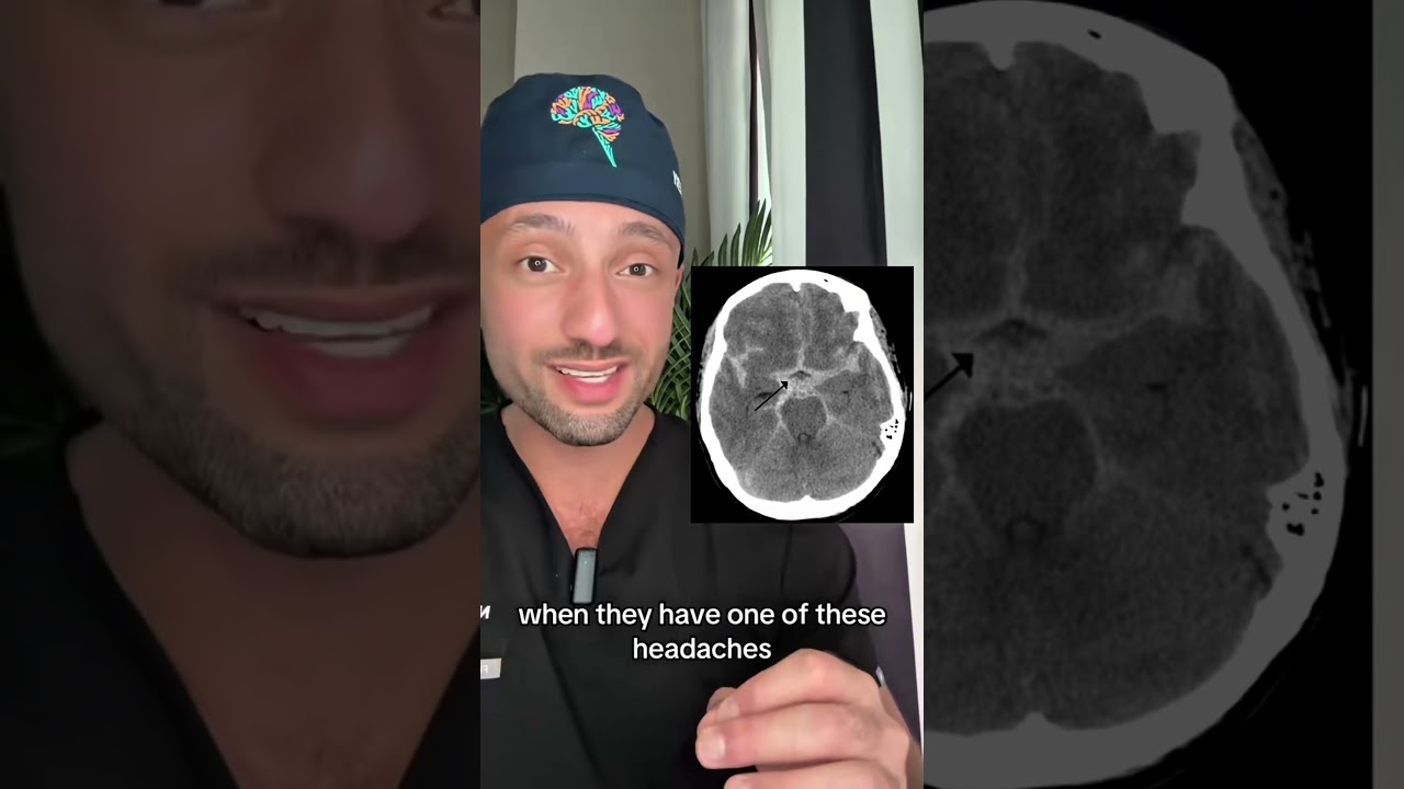 Brain bleed caught on camera #medical #doctor #science #brain #brainhealth #neurosurgery