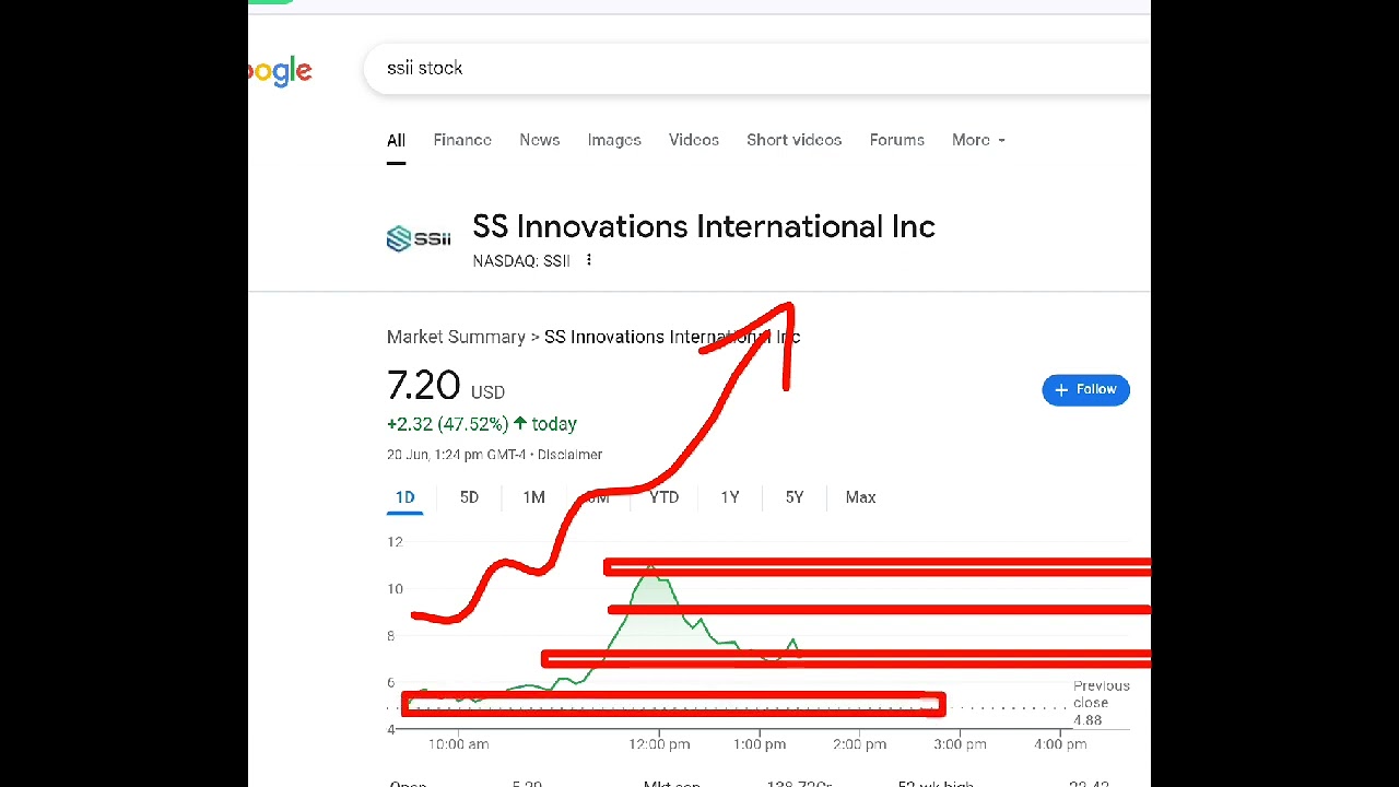SS Innovations International, ssii stock analysis buy or sell