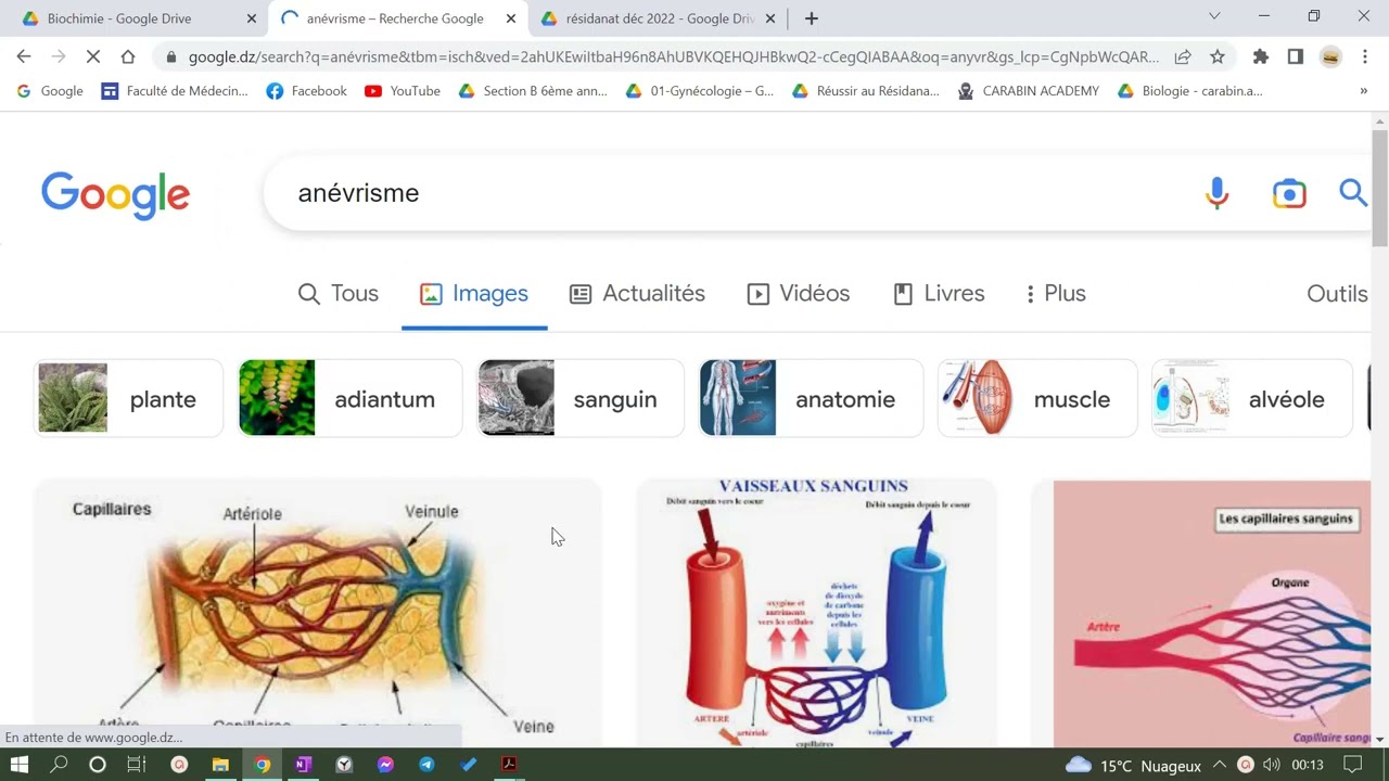 l'embolie (paradoxale , graisseuse , amniotique .....)