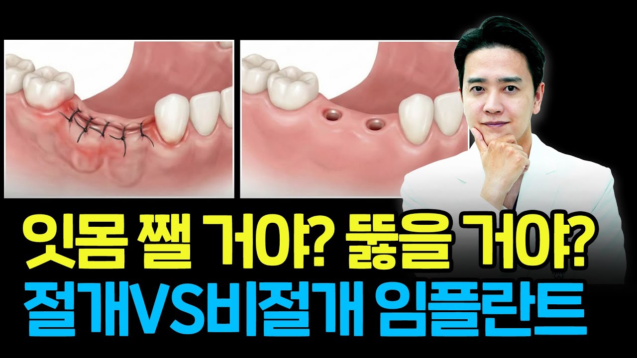 임플란트 수술, 절개 vs 비절개 어떻게 해야 좋을까?