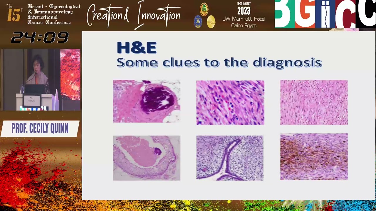 Spindle cell lesions of the breast byProf  Cecily Quinn