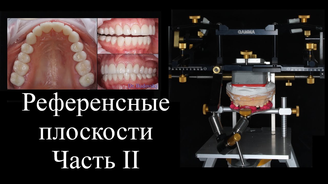Референсные плоскости. Приёмы для переноса данных в артикулятор