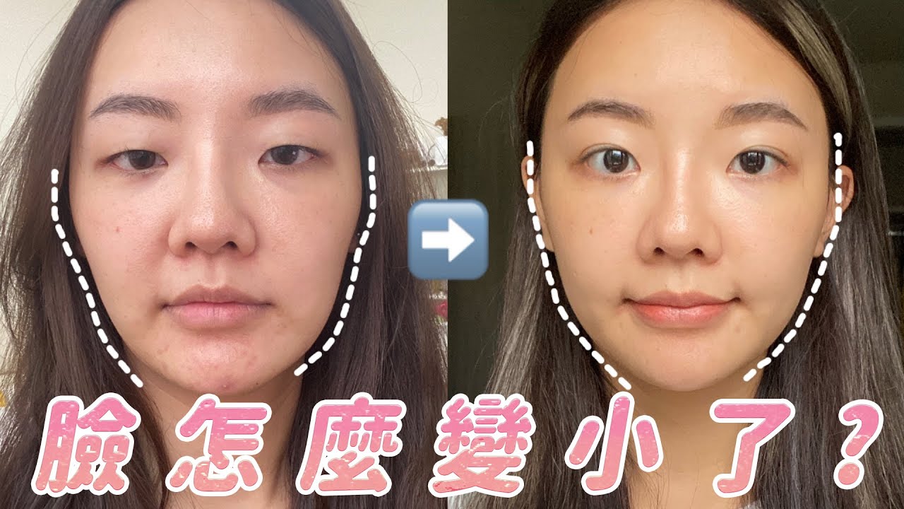 音波拉提三個月恢復全記錄｜臉變小的秘密是😳肉毒抬頭紋？頰凹玻尿酸？｜福爾思庭