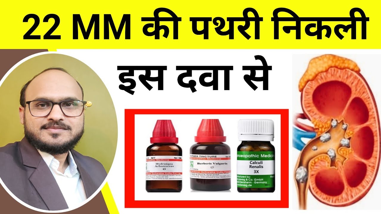 Kidney stone / renal stone homeopathic medicine / kidney stone pain relief / pathri ka ilaj & dawai