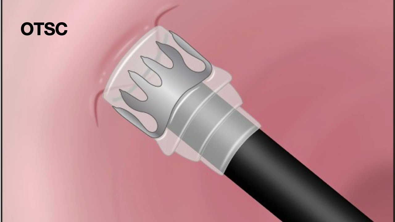 HCC 1472-Lesson-11a2 -Hemostatic Devices-Over the Scope Clips