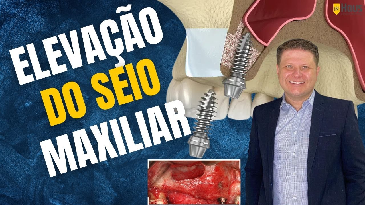 📍LEVANTAMENTO DE SEIO MAXILAR - AULA COMPLETA