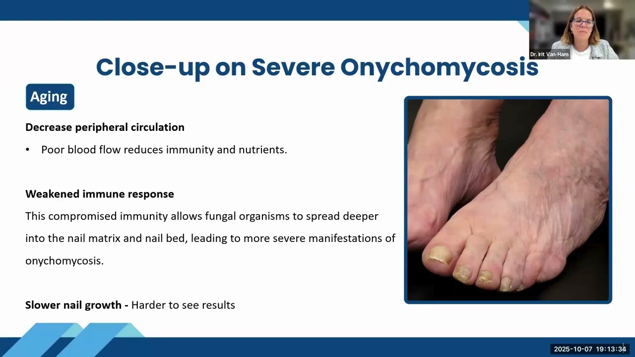 Webinar: Ruth Ruttan x ToeFX: The Science of Photodisinfection for Onychomycosis Treatment