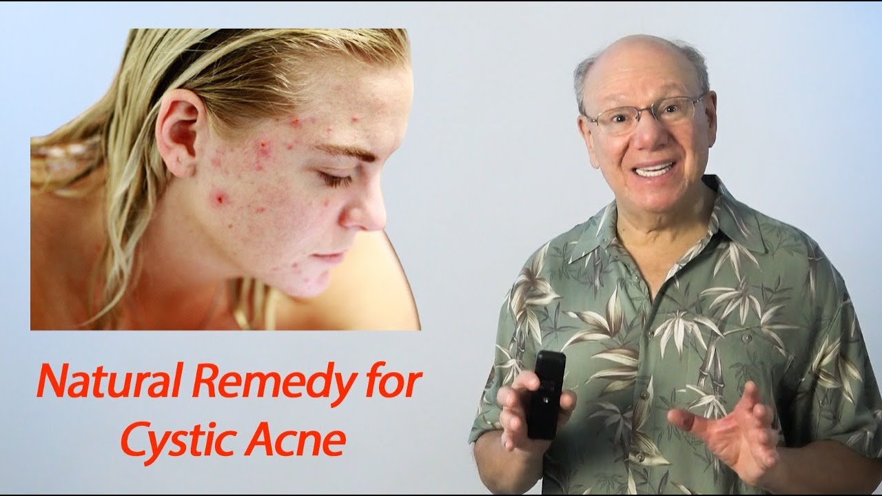 Natural Remedy for Cystic Acne