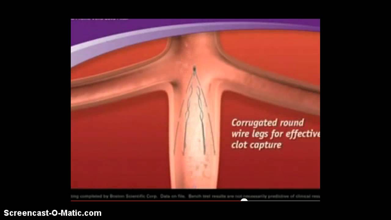 IVC Filter