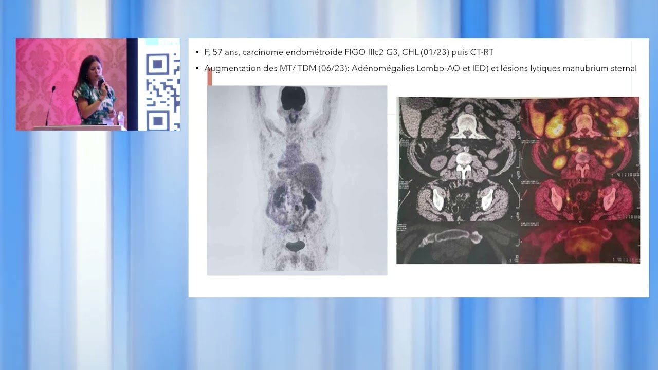 Les Journées d'échographie Septembre 2024 :Place du Pet Scan en carcino gynécologie: Dr Iméne Yeddes