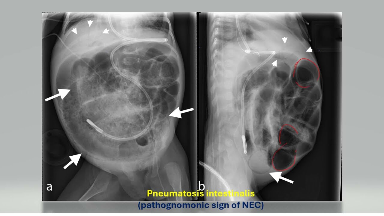 Necrotizing Enterocolitis (NEC)