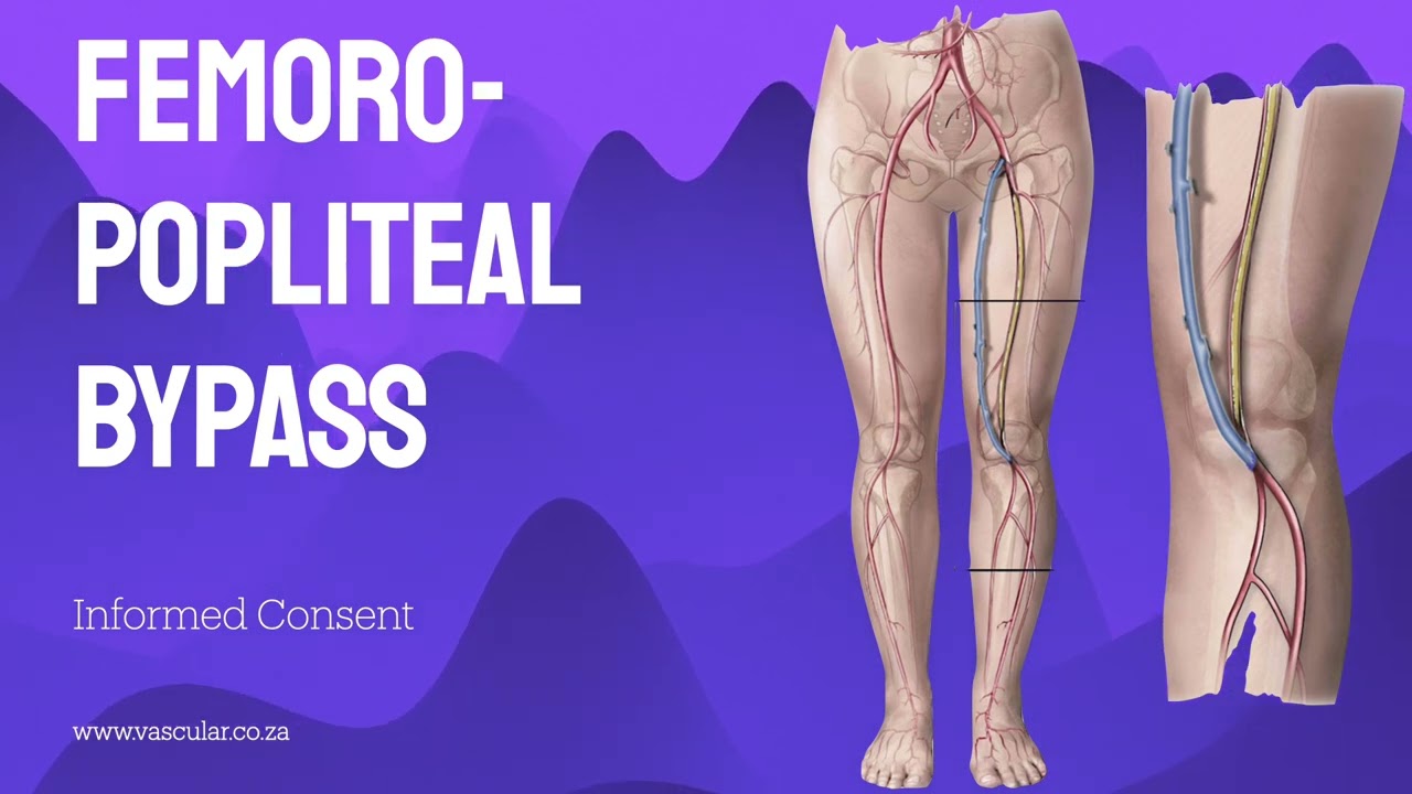 Femoro-popliteal Bypass - Informed Consent