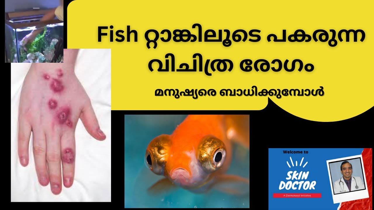 Fish റ്റാങ്കിലൂടെ പകരുന്ന വിചിത്ര രോഗം /Fish tank Granuloma/Fish hobbyists must watch .