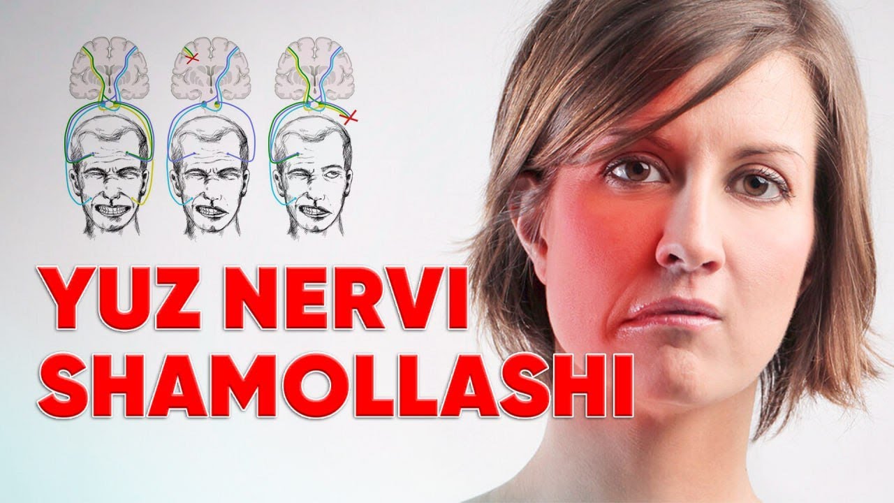 YUZ NERVI SHAMOLLANISHI // YUZ NERVI SHAMOLLANISHINI DAVOLASH YUZ QIYSHAYIB QOLISHI. YUZ FALAJI DAVO