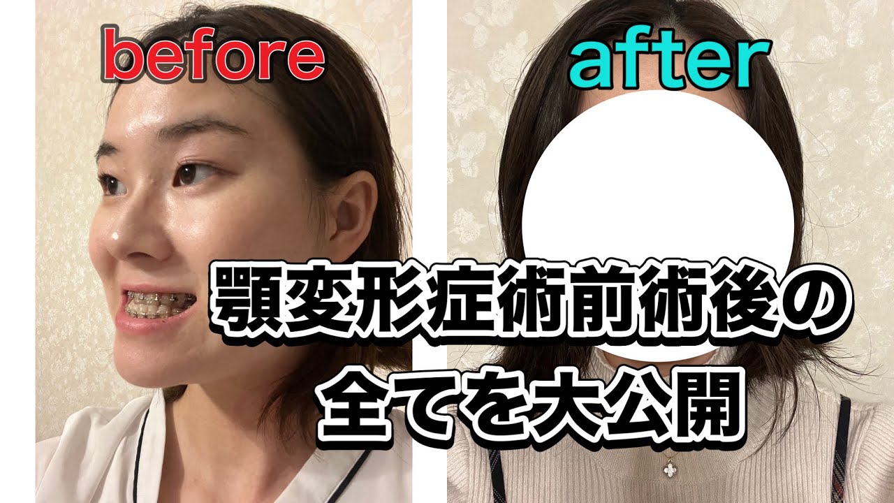 【顎変形症】衝撃のビフォーアフター！術前術後の全てを大公開します！黒歴史確定⚠️グロいの苦手な方閲覧注意 【下顎前突】