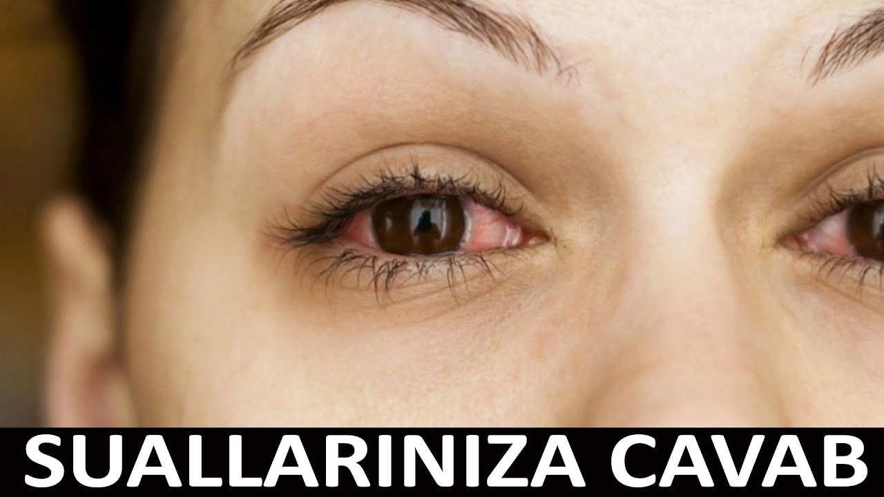 Gözdə qızarma və qaşınmanın MÜALİCƏSİ