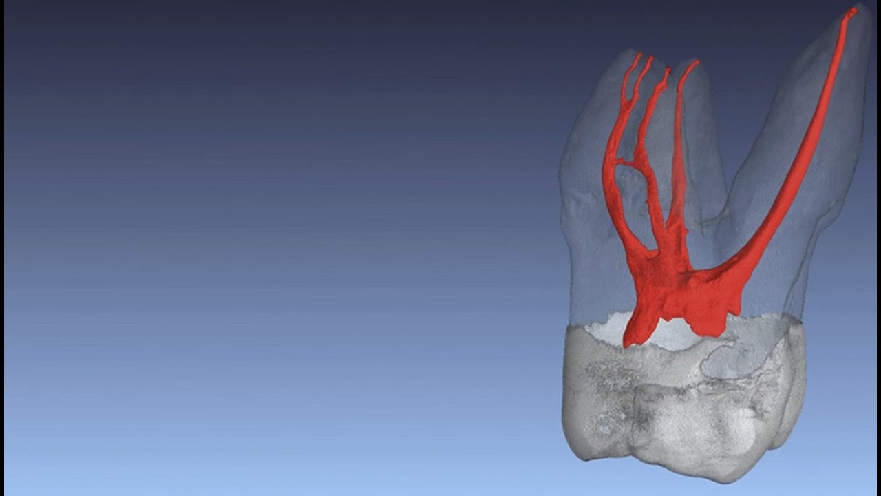 Root Canal Morphology and Access Cavity Preparation
