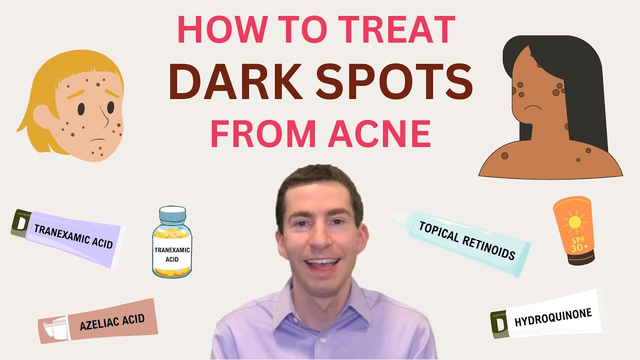 Dermatologist and acne expert explains how to treat dark marks from acne