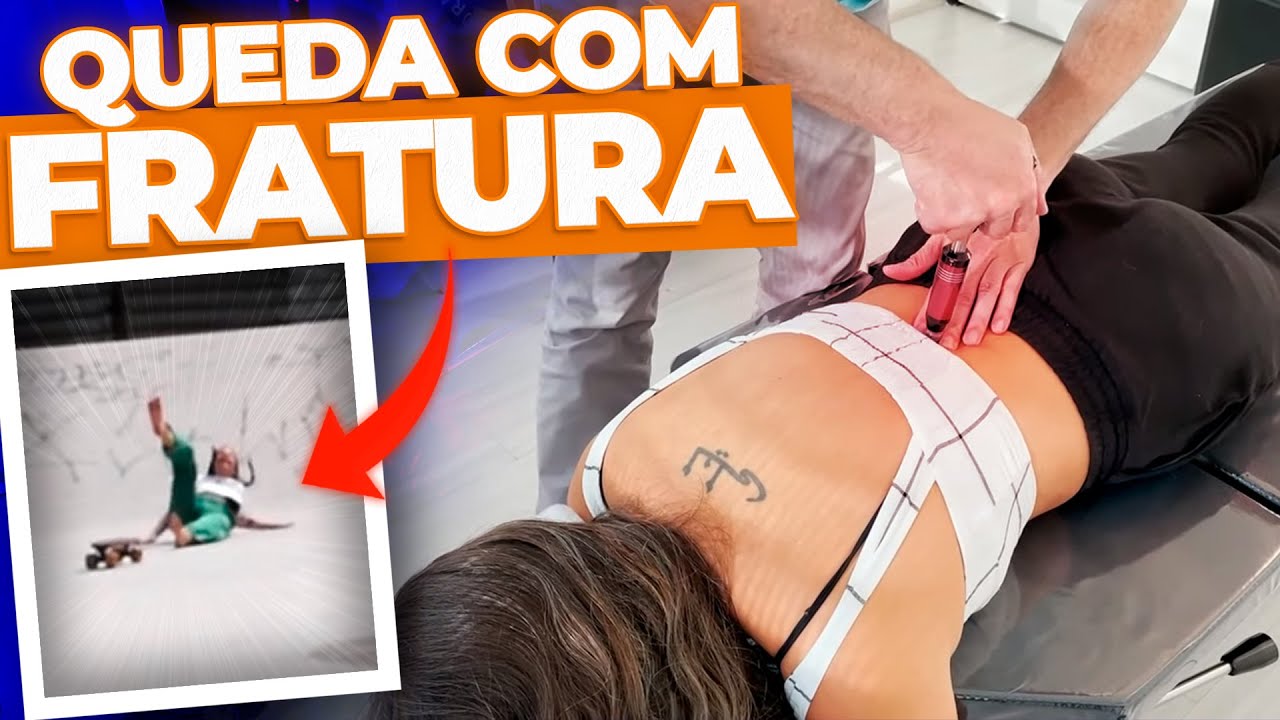 QUEDA de SKATE acaba em FRATURA na COLUNA