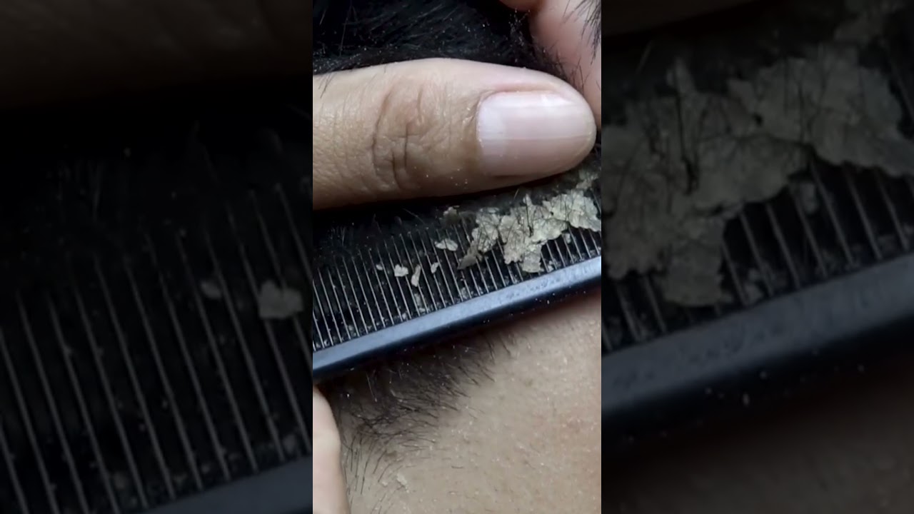dandruff scratching addiction #106