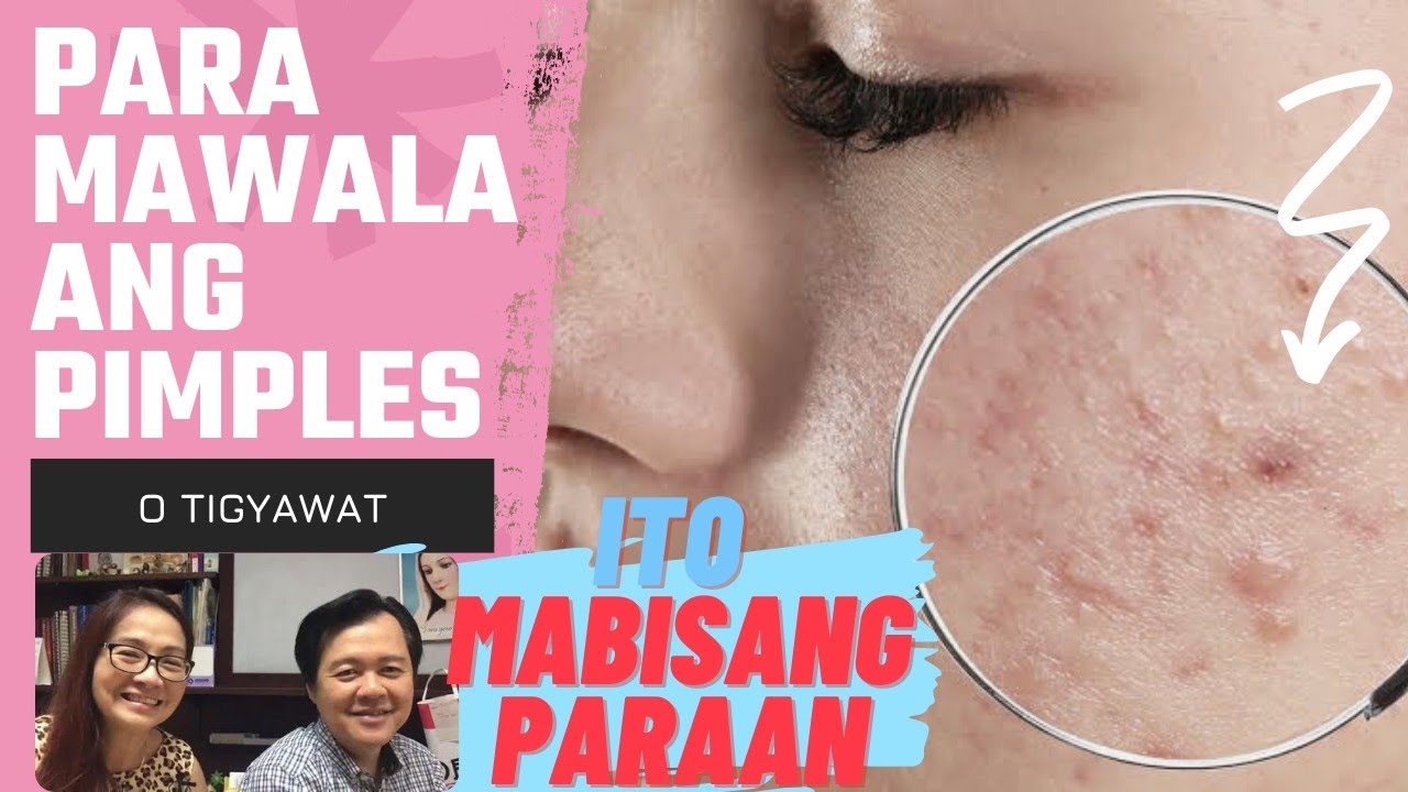 Para Matanggal ang Pimples o Tigyawat: Ito Mabisang Paraan - by Doc Katty Go and Doc Willie Ong