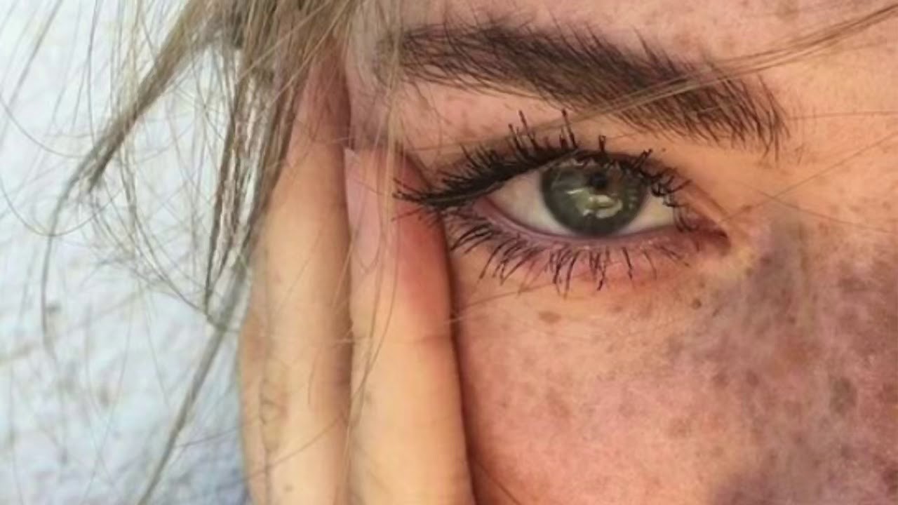✨ • Get freckles In under 24 hours || Subliminal • ✨
