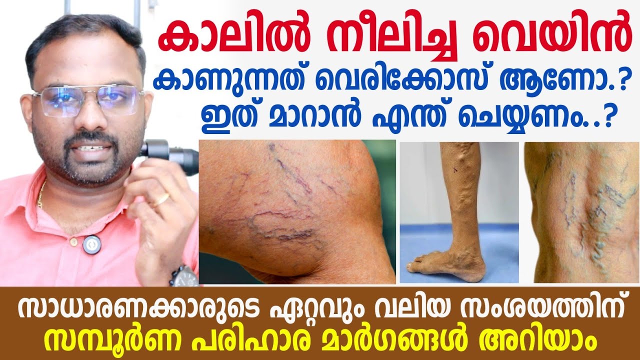 കാലിൽ നീലിച്ച് തടിച്ച ഞരമ്പുകൾ കാണുന്നത് വെരിക്കോസ് ആണോ ? ഇത് മാറാൻ എന്ത് ചെയ്യണം ? Varicose Vein