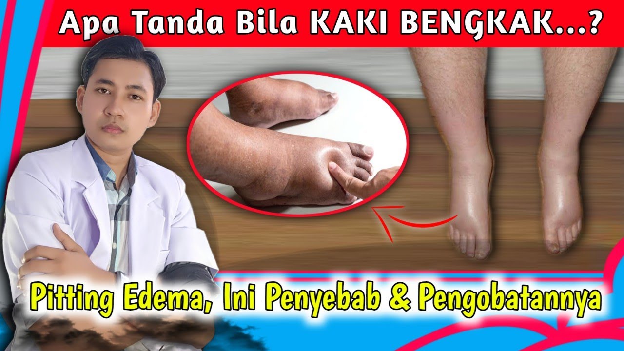 Pitting Edema, Ketahui Penyebab dan Cara Mengatasinya || dr. Andi