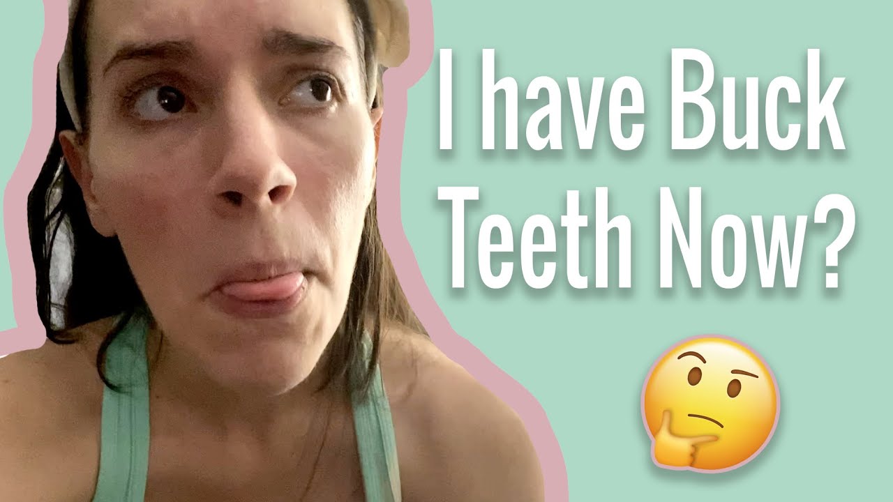 Invisalign Journey - Tray #16
