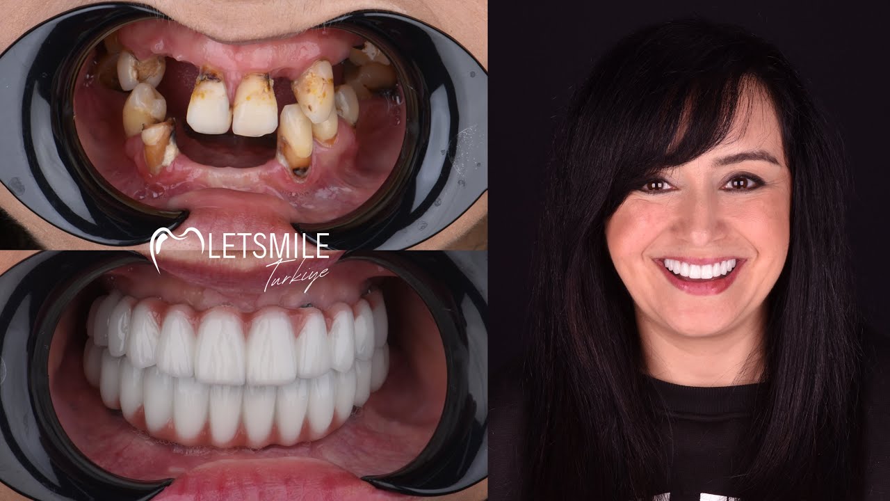 ANTALYTA DENTAL IMPLANT | ALL ON SIX IMPLANT | ALL ON FOUR IMPLANT | LETSMILE TURKIYE | ANTALYA