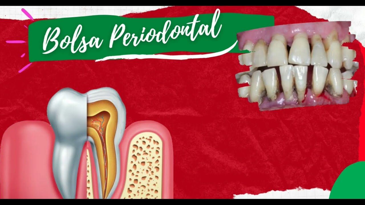 Bolsa Periodontal