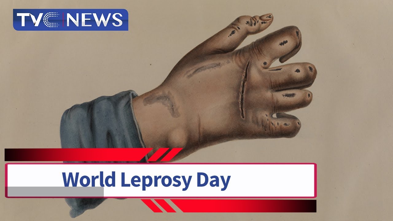 World Leprosy Day | Reeducate the Public About Leprosy