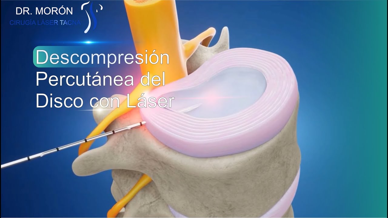Descompresión Percutánea del Disco con Láser