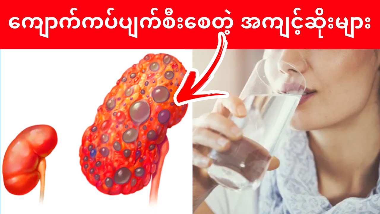 ‼️ကျောက်ကပ်မပျက်စီးချင်ရင် ဒီအကျင့်ဆိုး (၆) ခုကိုချက်ချင်းရှောင်ပါ